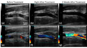 Representative US B-mode images (first row) and color Doppler images (second row) taken before, right after and two weeks after microtripsy thrombolysis treatment in a subacute pig